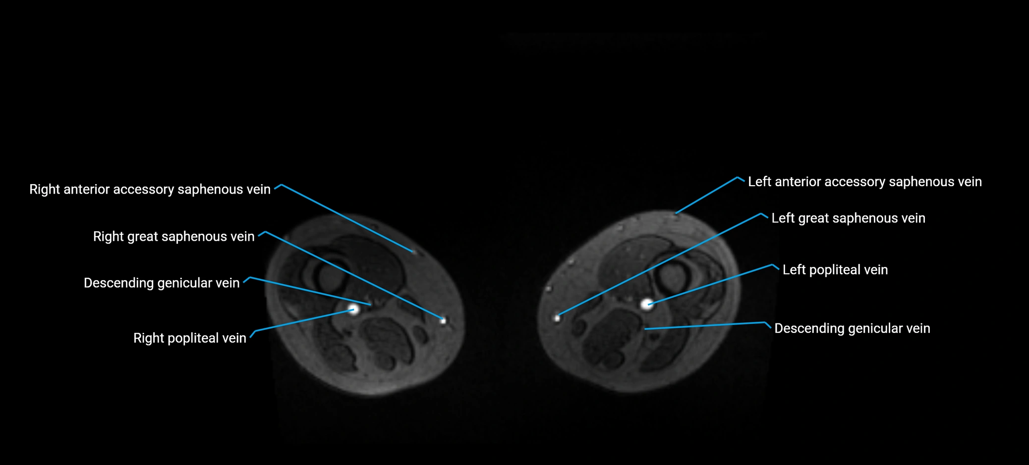 MRV abdomen pelvis & lower limb axial cross sectional anatomy labelled MRI image 321.webp